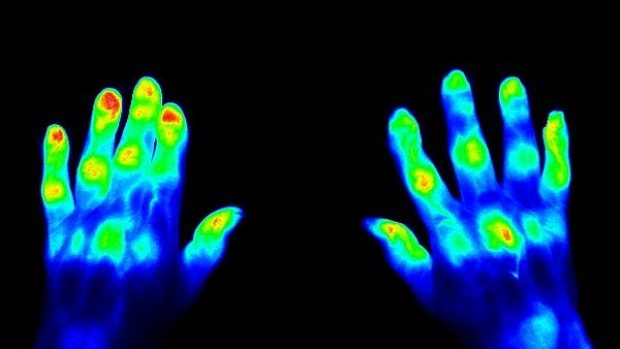 Ruce postižené revmatoidní artritidou (45 vteřin po aplikaci kontrastního barviva)