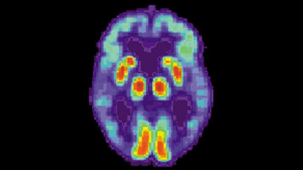 Mozek pacienta trpícího Alzheimerovou chorobou - snímek pořízený pozitronovou emisní tomografií (PET)