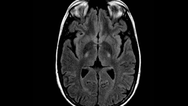 Mozek pacienta trpícího amyotrofickou laterální sklerózou na snímku z magnetické rezonance