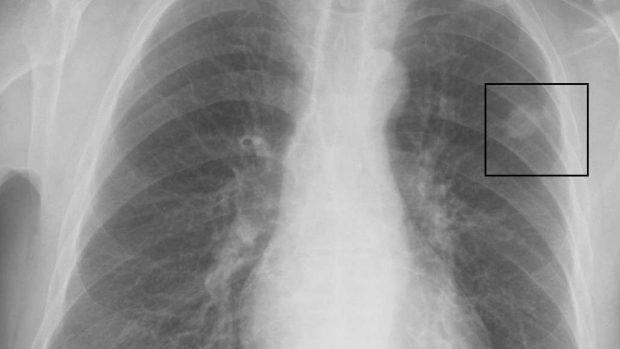 Rentgen hrudníku ukazuje nádor v levé plíci