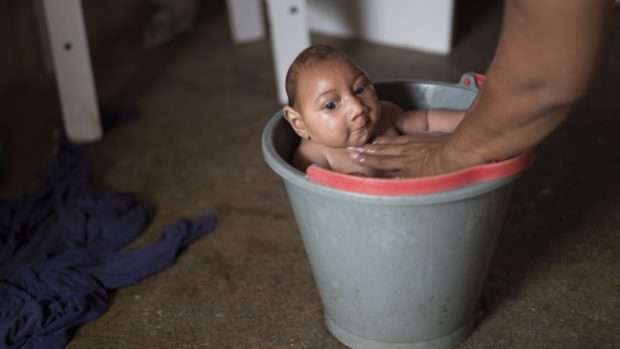 Brazilský novorozenec postižený mikrocefalií