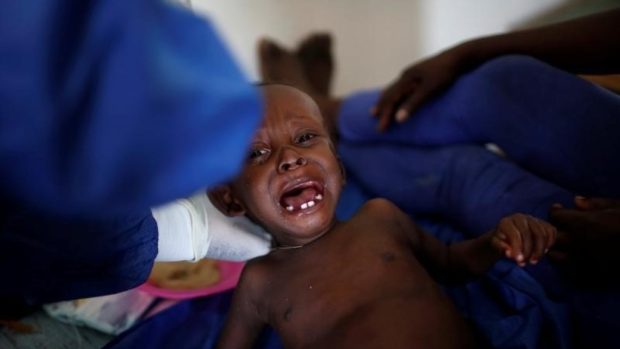 V nemocničním centru pro léčbu cholery na Haiti ošetřují dítě